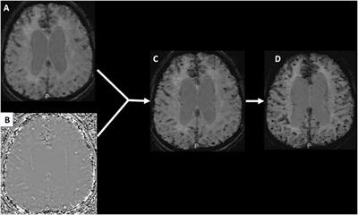 Frontiers | Neuroimaging Of Cerebral Small Vessel Disease And Age ...